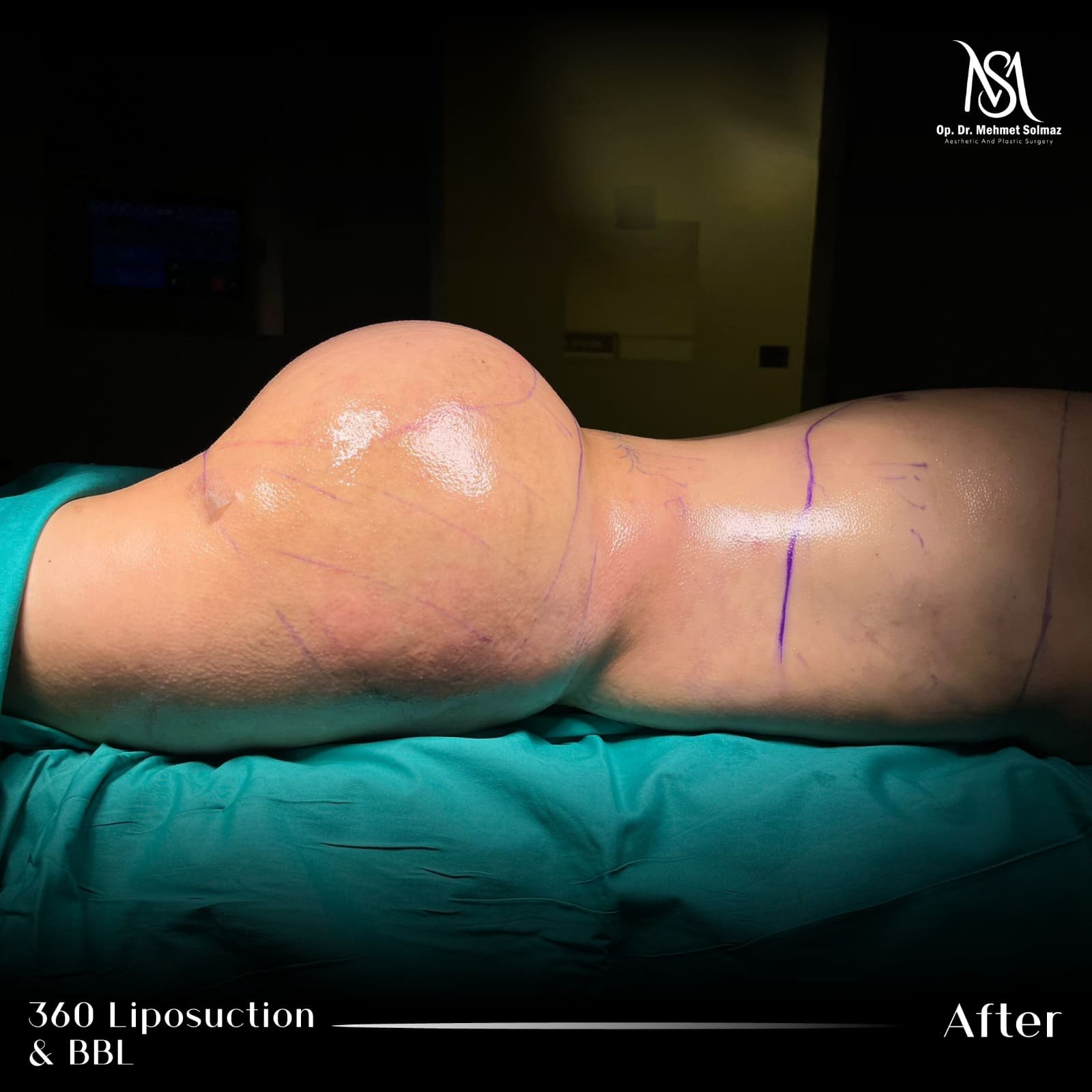 BBL contour, 4 months after