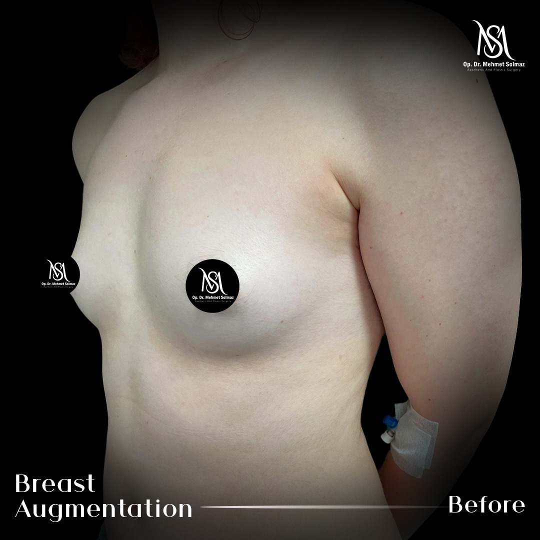 Breast augmentation