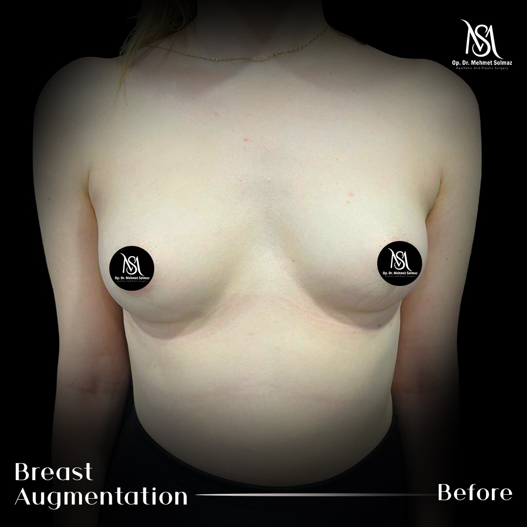 Breast augmentation · 3 months