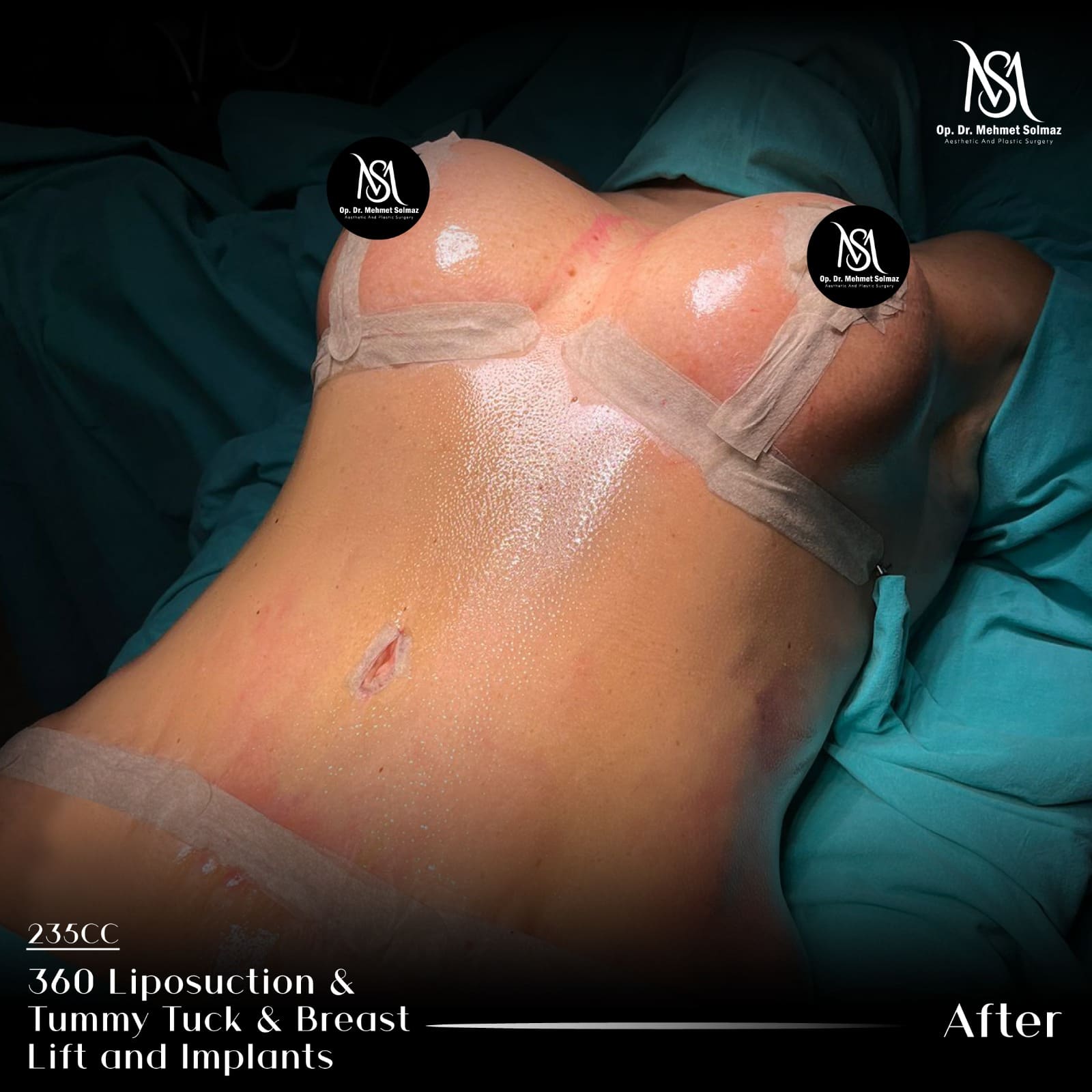 Breast implant, settled result
