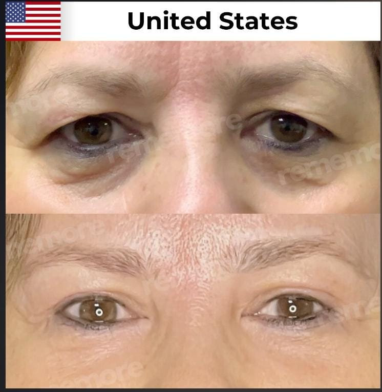 Eyelid surgery