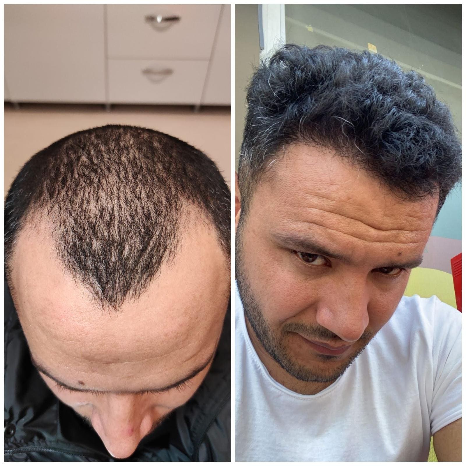 Hair transplant