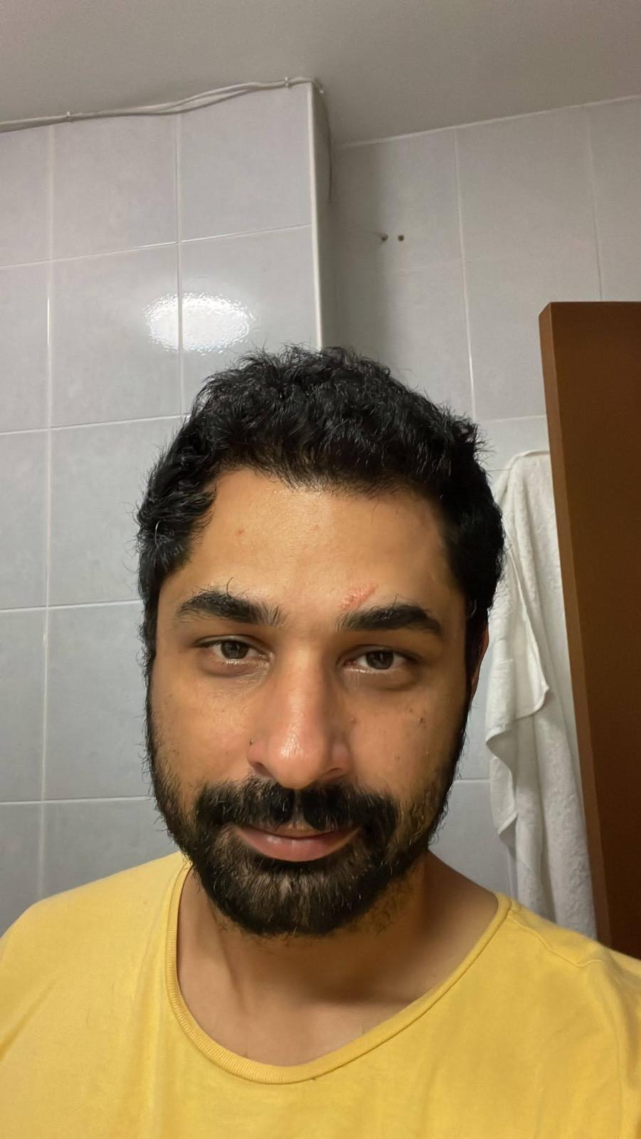 Hair Transplant FUE