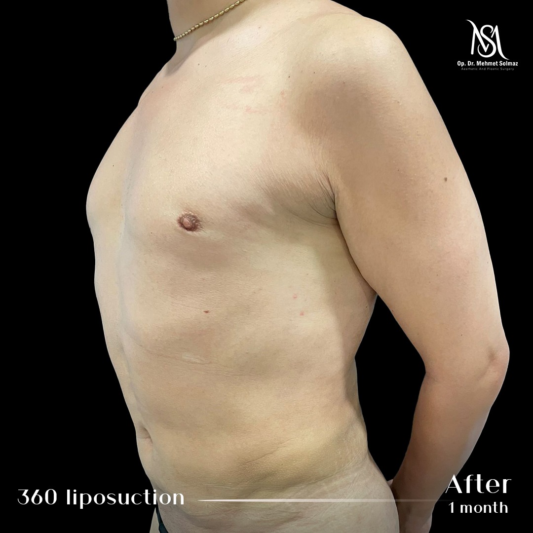 Liposuction