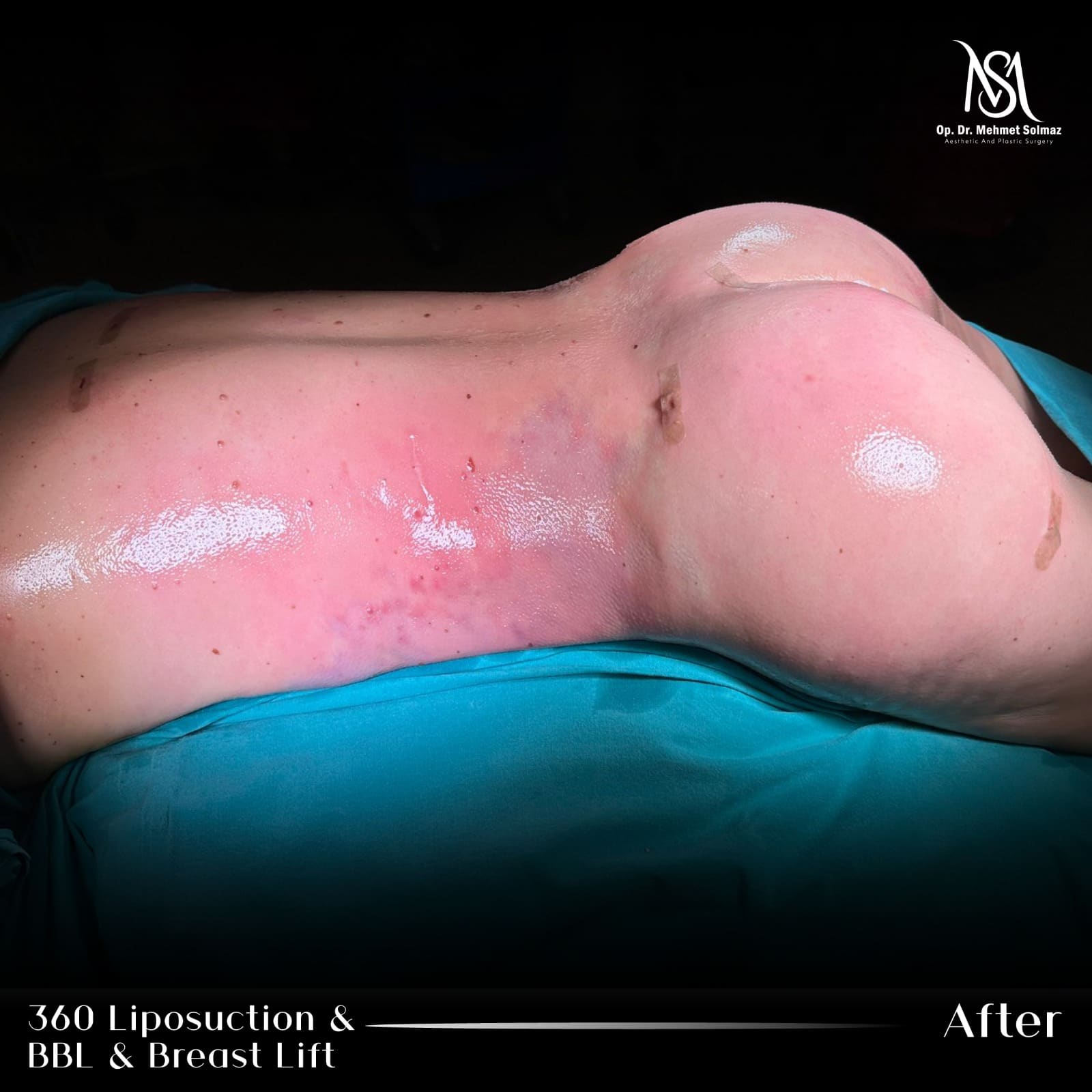 Tummy tuck