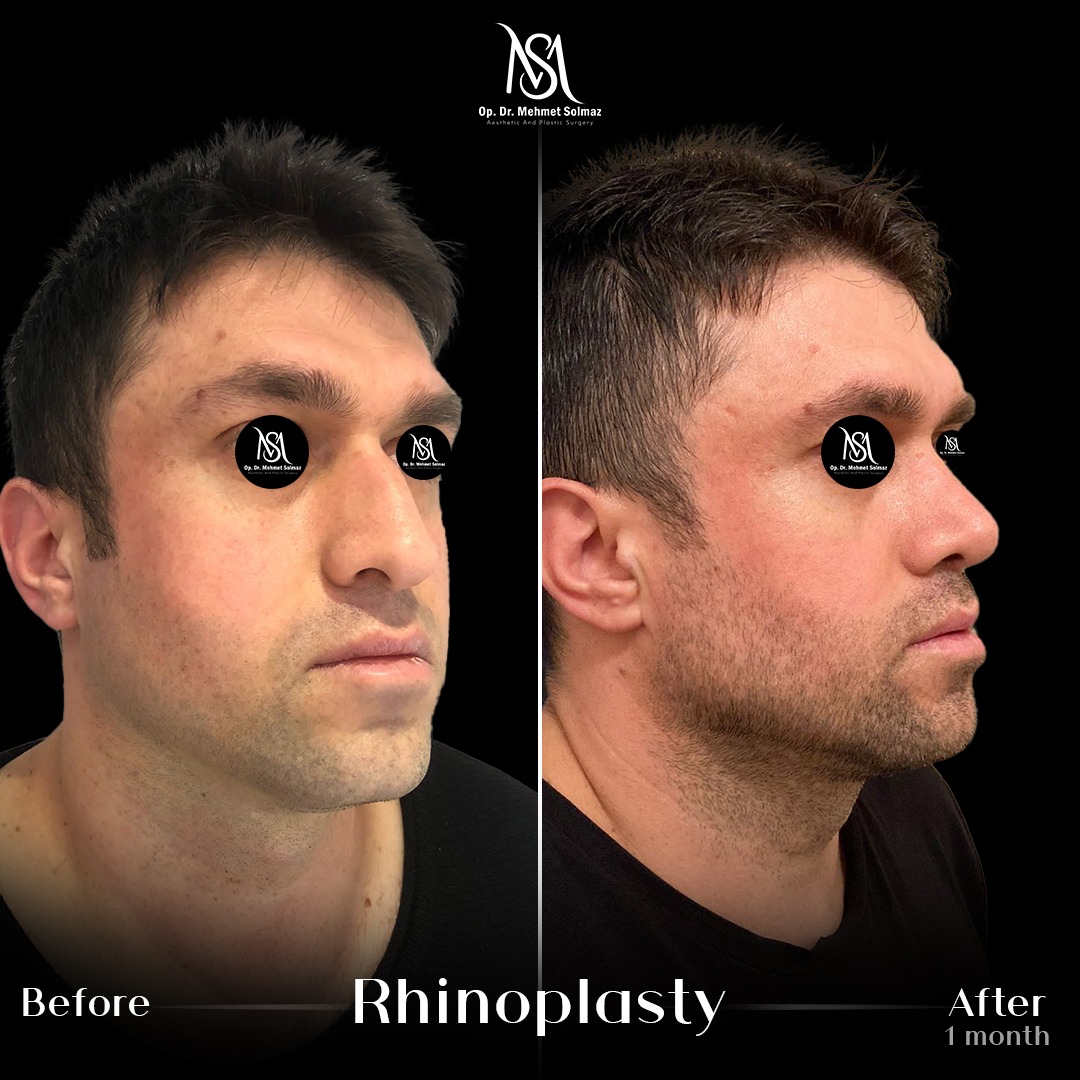Rhinoplasty